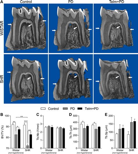 Alveolar Bone Loss