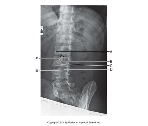 Rpo Lumbar Spine Diagram Quizlet