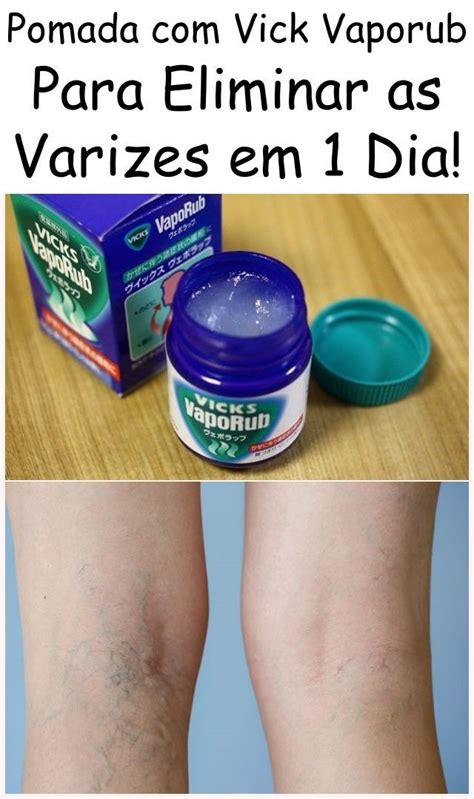 Pomada Com Vick Vaporub Para Eliminar As Varizes Em 1 Dia Vicks