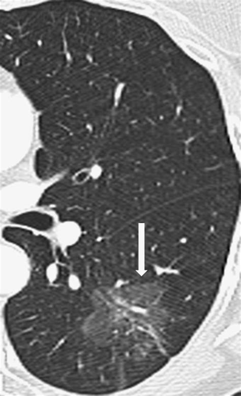 Primary Adenocarcinoma Of Lung A Pictorial Review Of Recent Updates European Journal Of Radiology