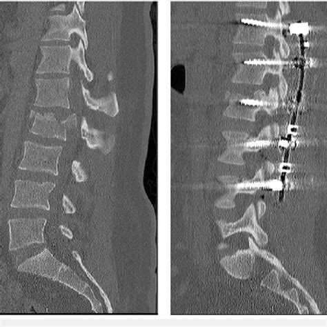 Typical Preoperative And Postoperative Imaging For A Patient Included