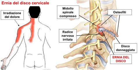 Ernia Del Disco Cervicale Dott Giuseppe Barone