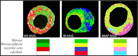 An illustration of color coding methods of VH-IVUS, IB-IVUS, and IMAP ...
