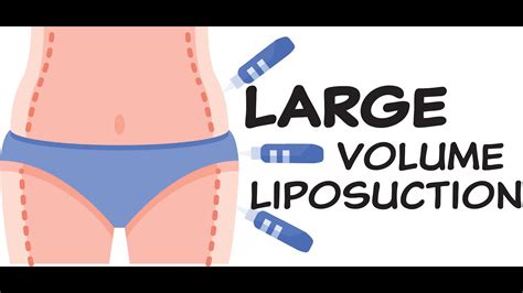 Large Volume Liposuction Youtube