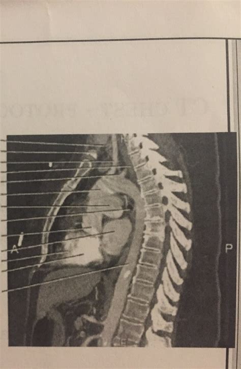 CT Chest Labeling Midsag Diagram Quizlet