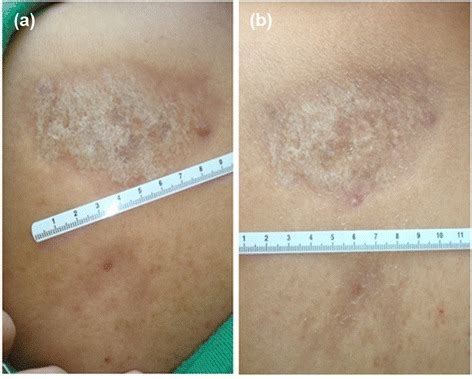 Morphea (Localized Scleroderma) — Symptoms and Prognosis | Lecturio