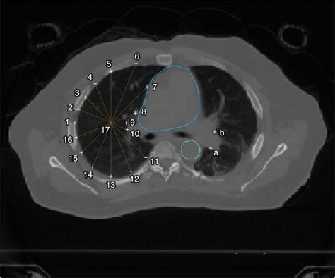 A slice of the CT image for the Mayo Clinic patient. Heart and aorta ...