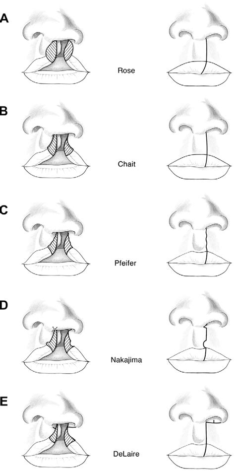 Cleft Lip Repair Techniques