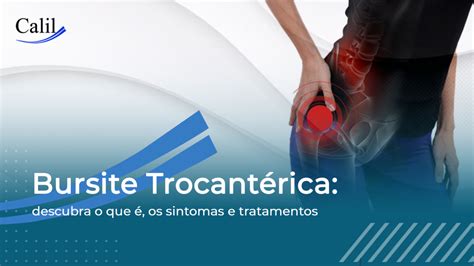 Bursite Trocantérica descubra o que é os sintomas e tratamentos Dr