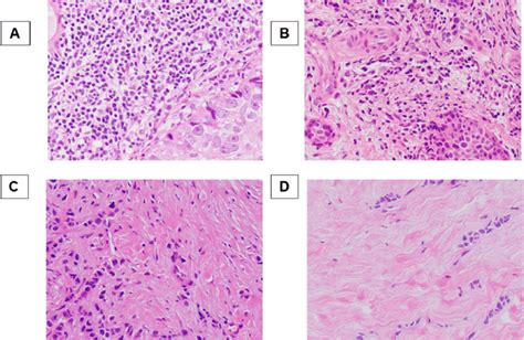 Histopathologic Analysis For Tumor Infiltrating Lymphocyte Til