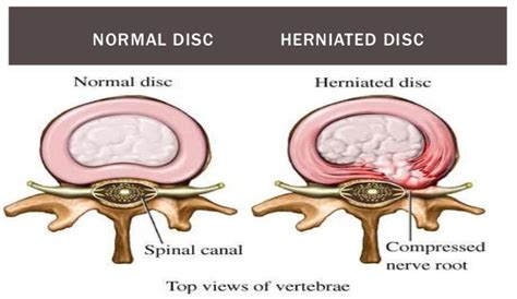 Intervertebral Disc Prolapseivdp