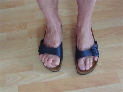 Bild I Have Extreme Hallux Valgus Interphalangeus At M Flickr