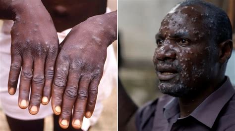 Pourquoi Le Mpox A T Il T D Clar Une Urgence Mondiale Causes Et