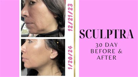 Sculptra 30 Day Before And After 2 Vials Collagen Sculptra Youtube