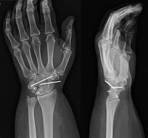 Scaphoid Fracture Avascular Necrosis