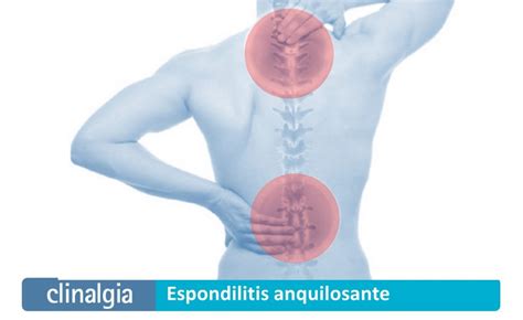 Espondilitis Anquilosante S Ntomas Y Tratamiento