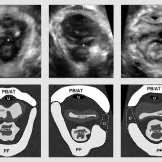 Transperineal Ultrasound Of The Pelvic Fl Oor Left Normal Middle