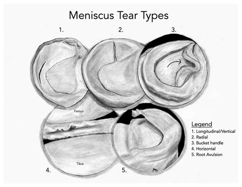 (PDF) Meniscus Tear Types MH 2022 08 03