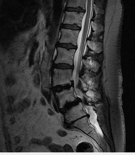 Preoperative Lumbar MRI Demonstrating L5 S1 Disc Bulge With Disc