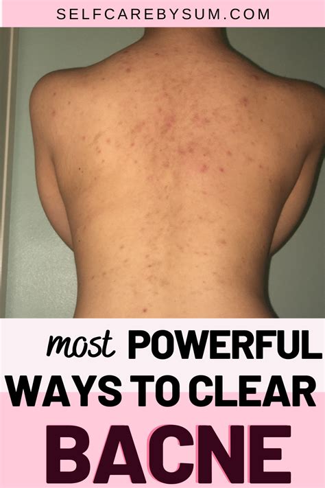 How To Get Rid Of Back Acne Finally Sbs Acne Solutions Bad Acne Back Acne Remedies