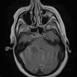 MRI brain with contrast axial view shows right cerebellopontine angle,... | Download Scientific ...