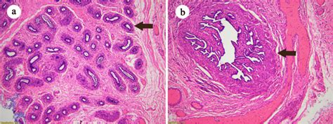 Histopathology A Viable Testicular Tissue Arrowhead Indicates A