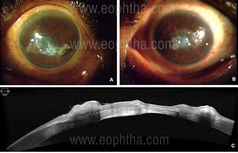 Gelatinous Drop Like Corneal Dystrophy