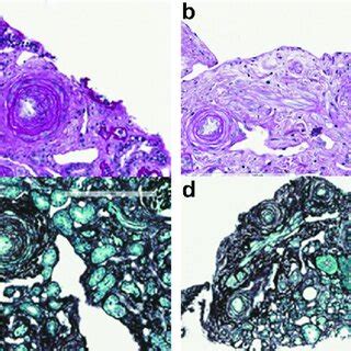 Examples Of Lesions Identified In Cluster Pas Stain Demonstrates