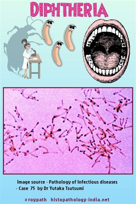 Pathology Of Diphtheria Acute Disease Pathology Medical Laboratory