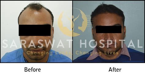 Hair Transplantation Before And After Results Saraswat Hospital