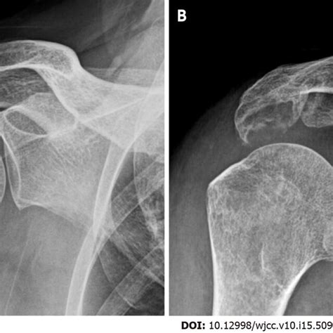 plain radiographs    shoulder show erosive change