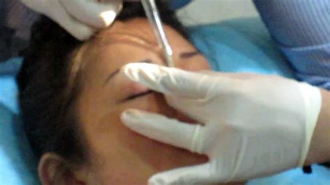 Fillers Injection For Sharper Nose Bridge Youtube