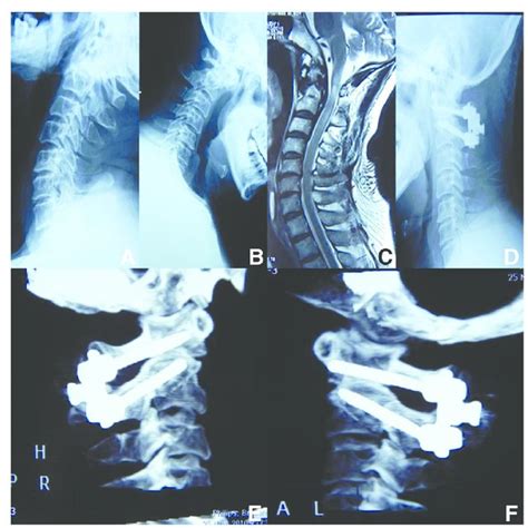 Entry Points Of Atlas Pedicle Screw Blue Dot And Atlas Lateral Mass Download Scientific