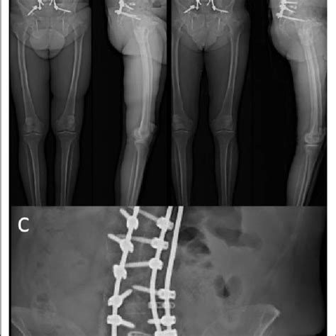 Radiographs Of Patient 8 A AP And Lateral Radiographs Taken 8 Days