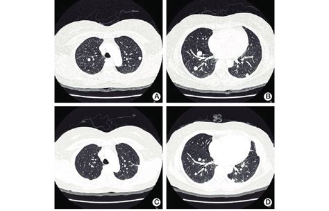 A B Initial Chest Computed Tomography Scans Showing Multiple