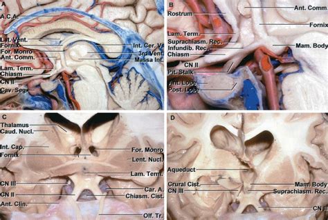 Archnoid Cyst