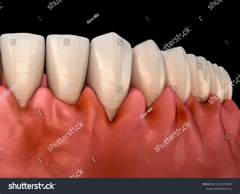 Gingivitis Inflammation Gums Dental 3d Illustration Stock Illustration