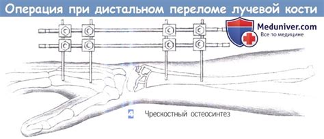 Фиксация при переломах спицами киршнера