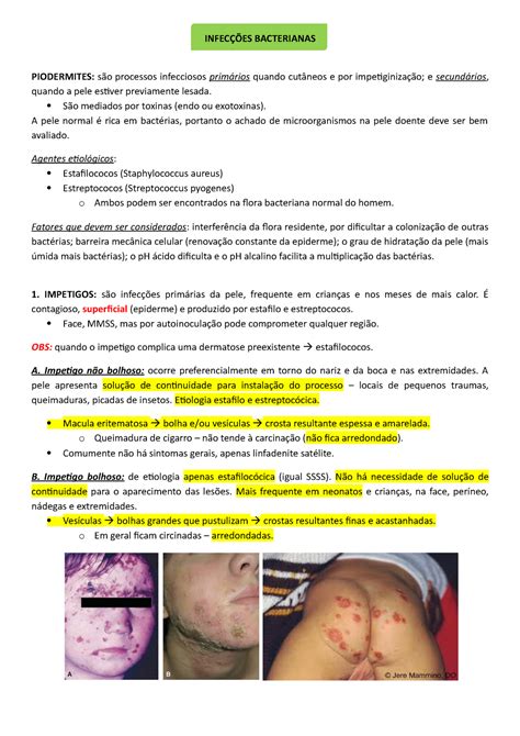 Infecções Bacterianas Dermato InfecÇÕes Bacterianas Piodermites São