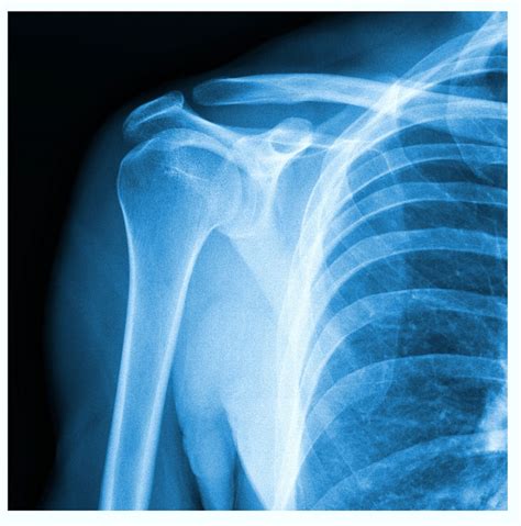 Shoulder Xray Diagnose Injury