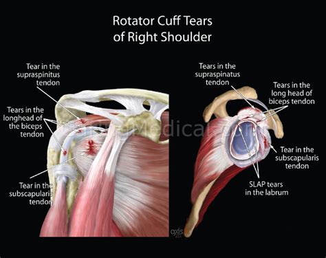 Partial Rotator Cuff Tear Do You Really Need A Surgery