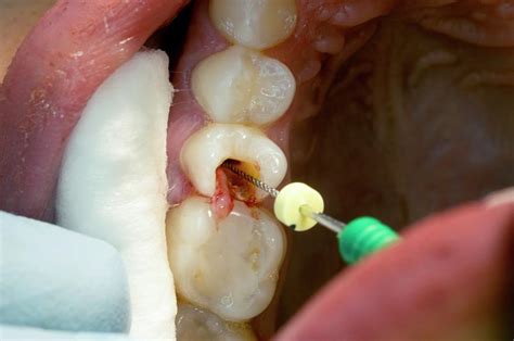 Root Canal Dental Surgery Photograph By Dr Armen Taranyan Science Photo Library