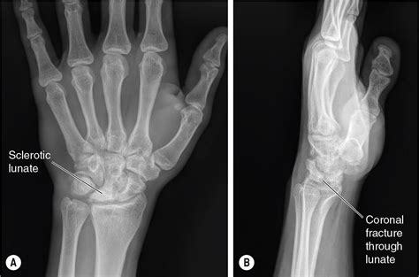 Procedures For Avascular Necrosis Of The Lunate Kienböck Disease