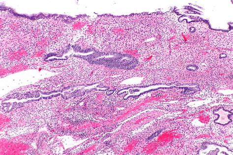 Endometrial Polyp Histology