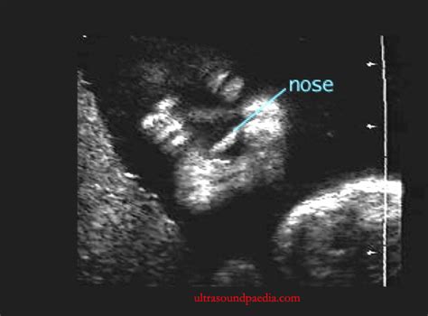 Hypoplastic Nose Ultrasounds