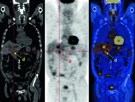 Recurrent Klatskin’s Tumor: Peritoneal Carcinosis | Radiology Key