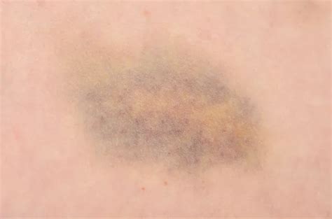 Hematoma Stock Photos Royalty Free Hematoma Images Depositphotos