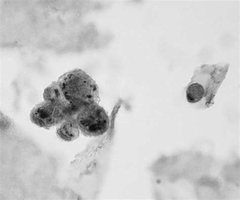 Diagnostic Lung Cytology Thoracic Key