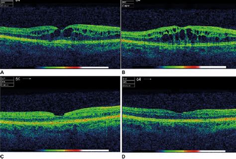 Radiation Retinopathy Eye News