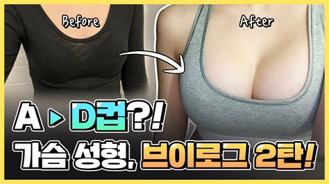 휴먼성형외과 가슴성형수술 리얼 브이로그 2탄😘 Youtube